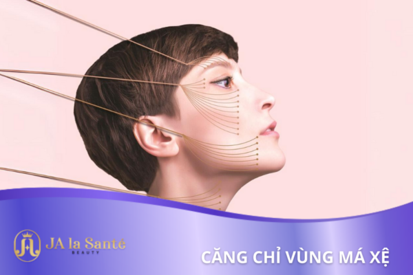 Căng chỉ vùng má xệ